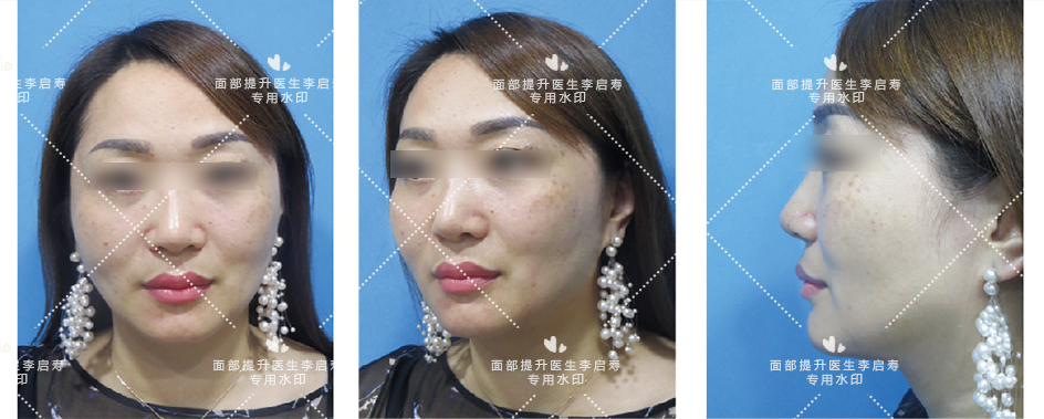 去眼袋苹果肌提升变化图,30岁面部轻微下垂眼袋泪沟