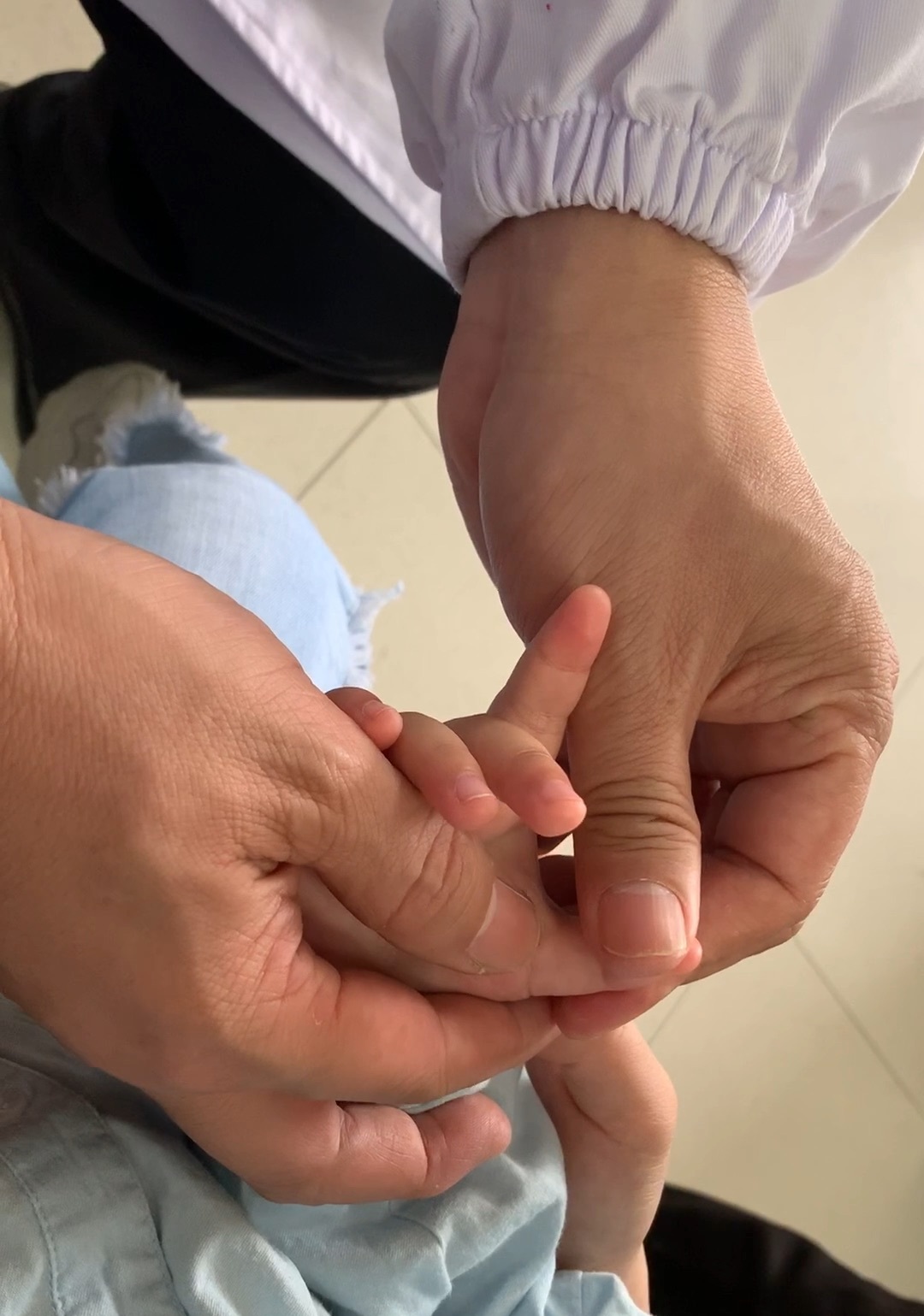 小儿狭窄性腱鞘炎应该怎么办？