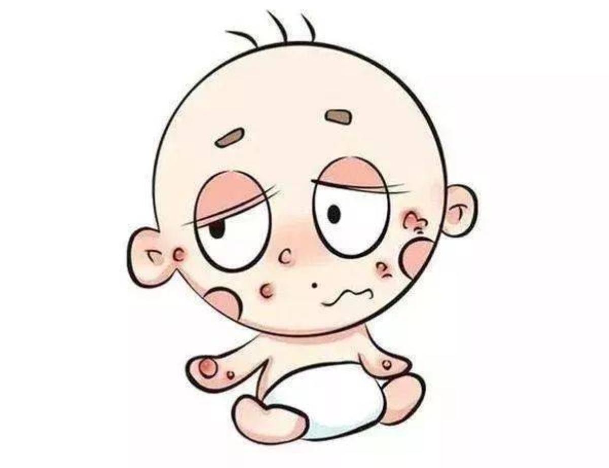 宝宝背后有疹子是什么疹子,宝宝出疹子会有什么疹子