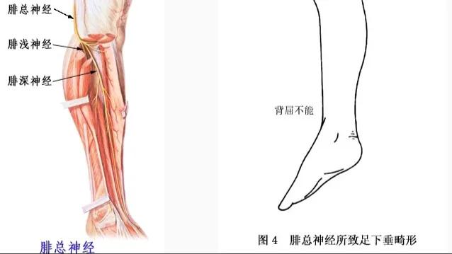 脉冲针灸对腓总神经损伤有效吗,腓总神经损伤针灸多长时间一疗程