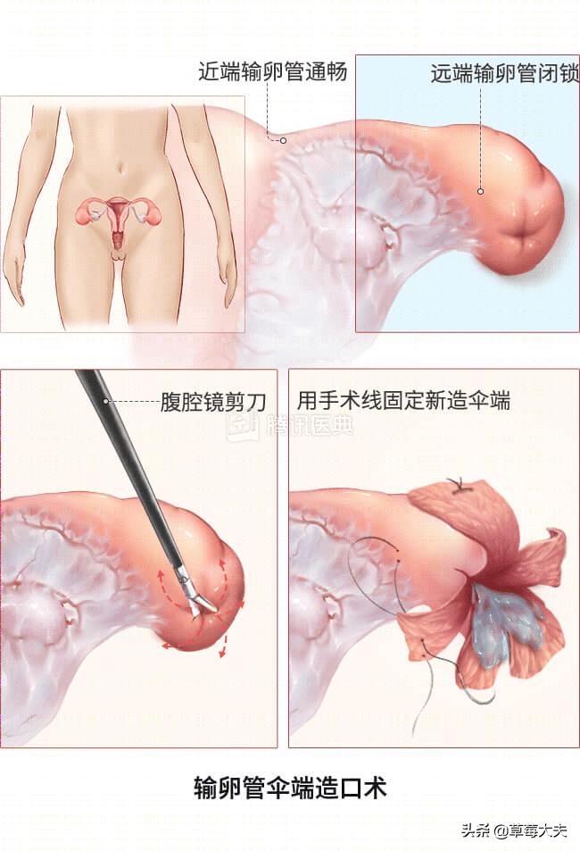 医生也成“催生婆”？不！是你输卵管出问题了......