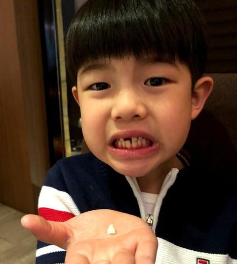 10岁门牙磕断后续治疗费用怎么算,门牙被同学磕断需赔付多少钱呢