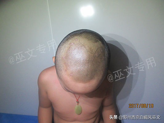 白癜风黑色素培植手术复发率高吗,黑色素种植术治疗白癜风的全过程