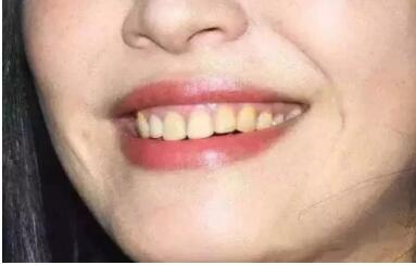 牙膏减少牙渍牙结石,去除牙菌斑清新口气牙膏