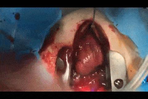 纳米技术让伤口快速愈合的凝胶,神奇胶水60秒缝合伤口