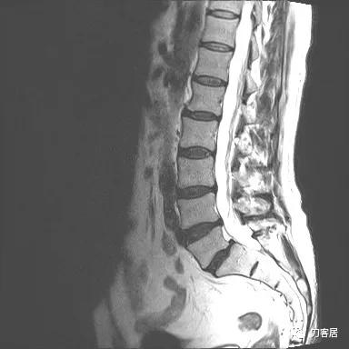 小针刀扎到坐骨神经会瘫痪吗,小针刀会切断坐骨神经吗