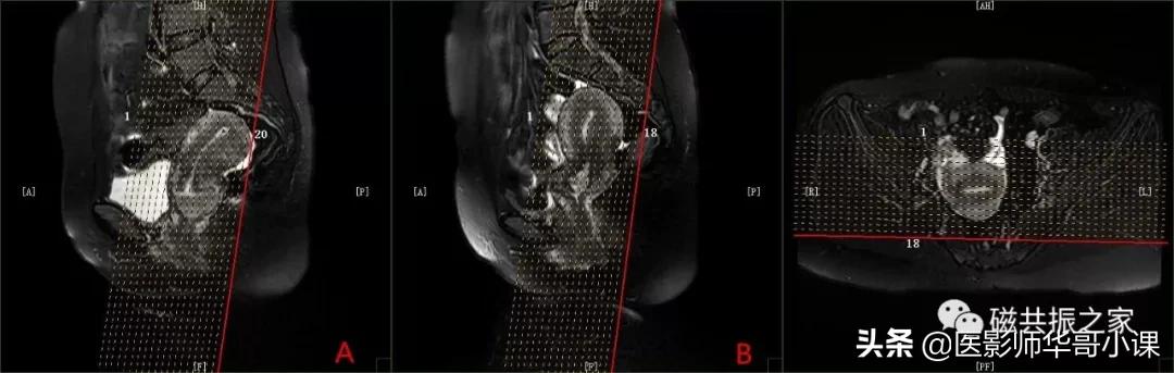 「精品课件」带大家看看，磁共振子宫MRI要如何扫描？