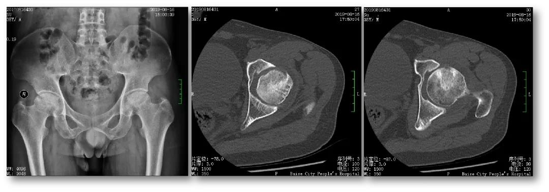 股骨头机器人手术微创,骨科机器人股骨颈手术