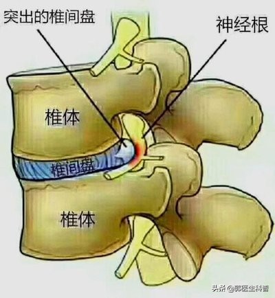 腰椎间盘突出术后复发的临床表现,极外侧型腰椎间盘突出容易复发吗