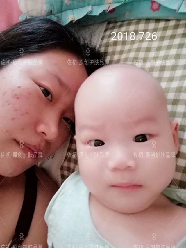 生完孩子烂脸,生完孩子脸上垮了怎样处理