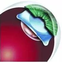 术前必须做的检查项目,近视手术的几种方式优缺点对比图