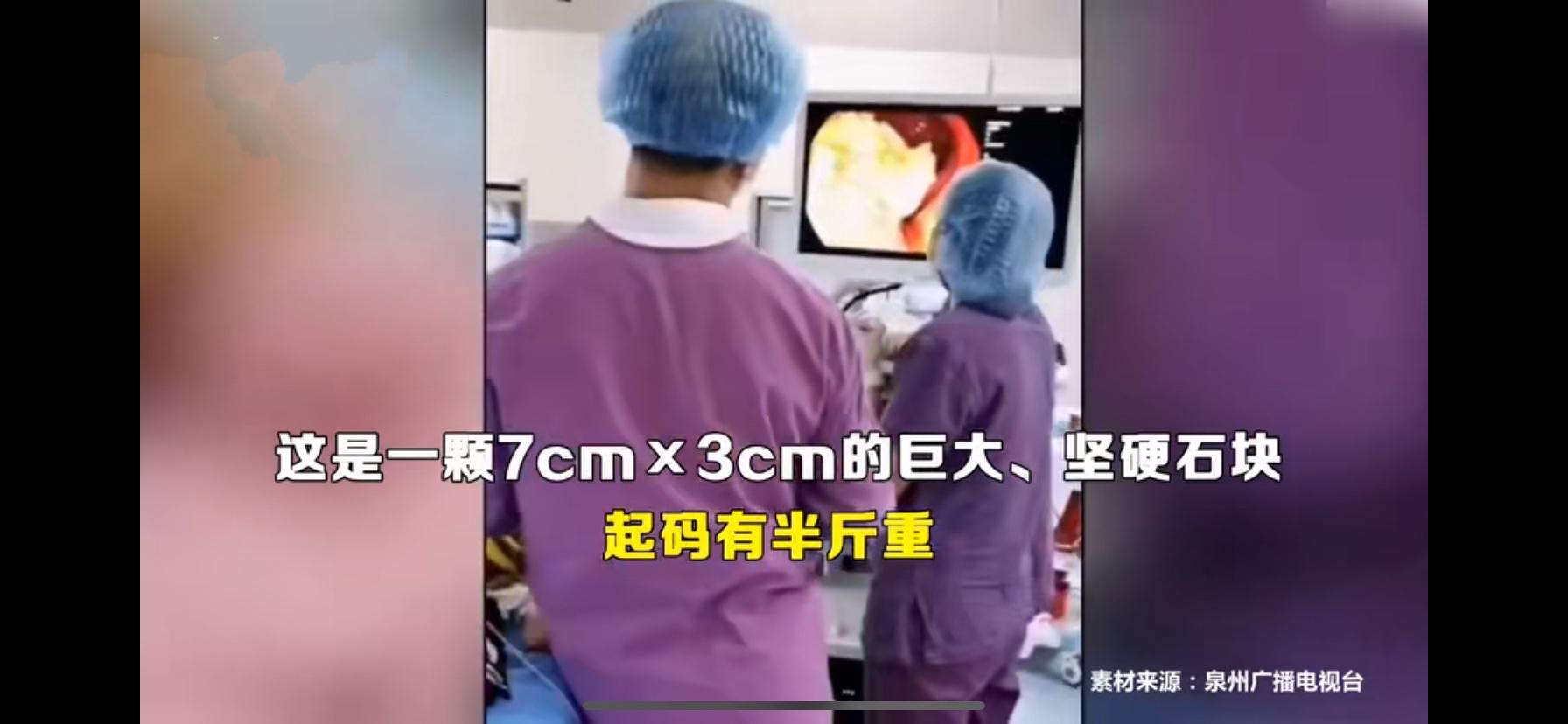 连吃5个柿子,吃了4个柿子长结石