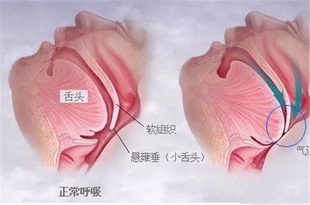 有人突发脑出血怎么办？医生教你急救办法，家人有高血压的快看