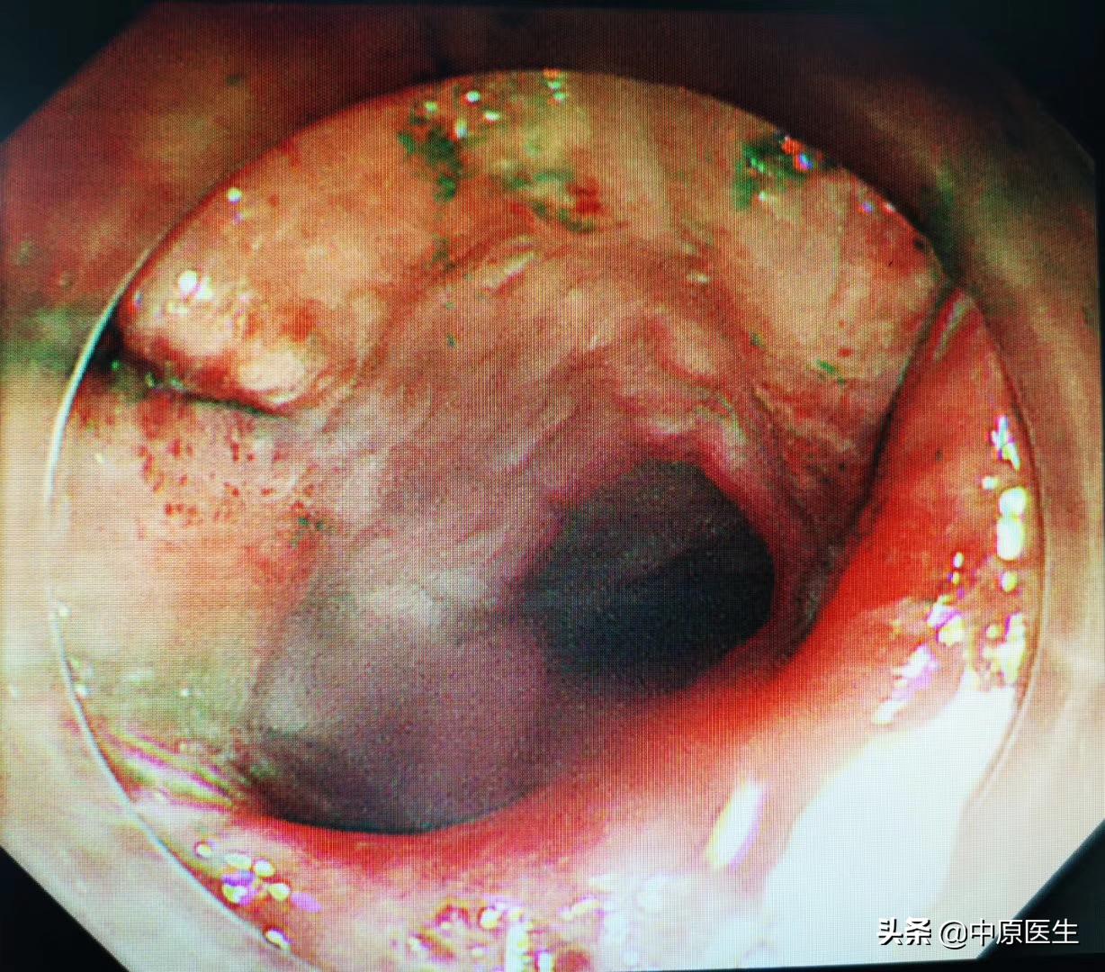 老人吃饭被骨头卡喉咙用什么药,老人被一粒饭卡喉咙