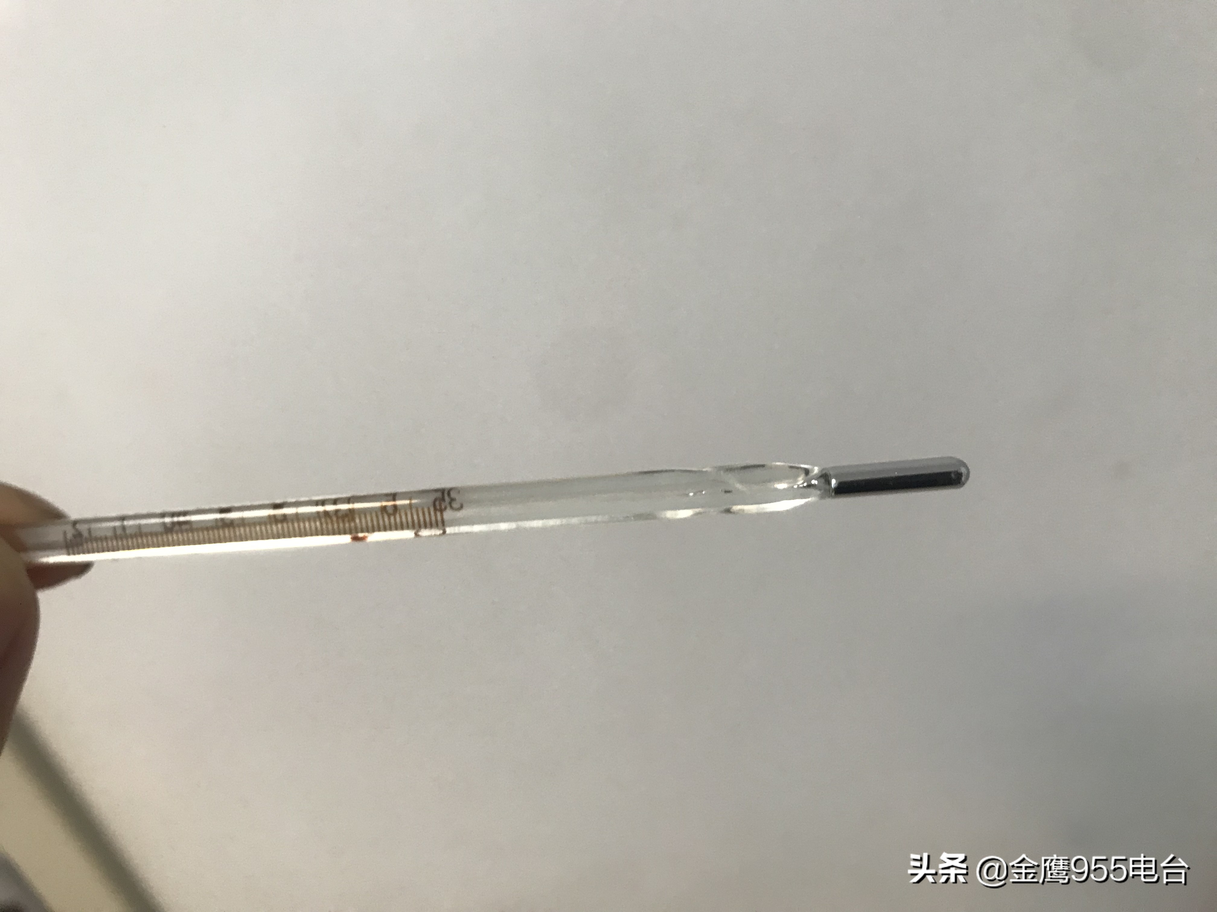 家长注意了!男孩不慎摔倒温度计插入眼眶三年驱汞治疗仍有残余