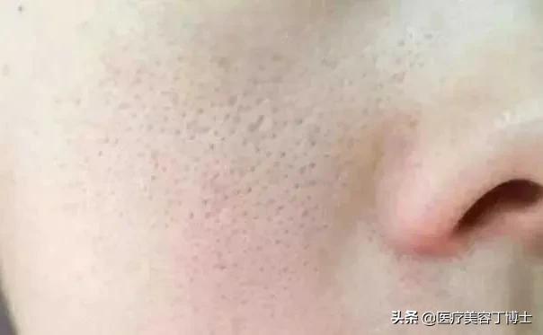 毛孔粗大皮肤又干是什么肤质,毛孔粗大的克星怎么解决