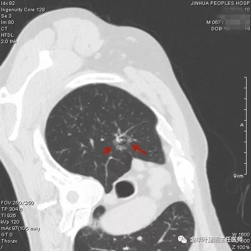 肺多发转移癌主要治疗手段,右肺上叶癌怎么治疗