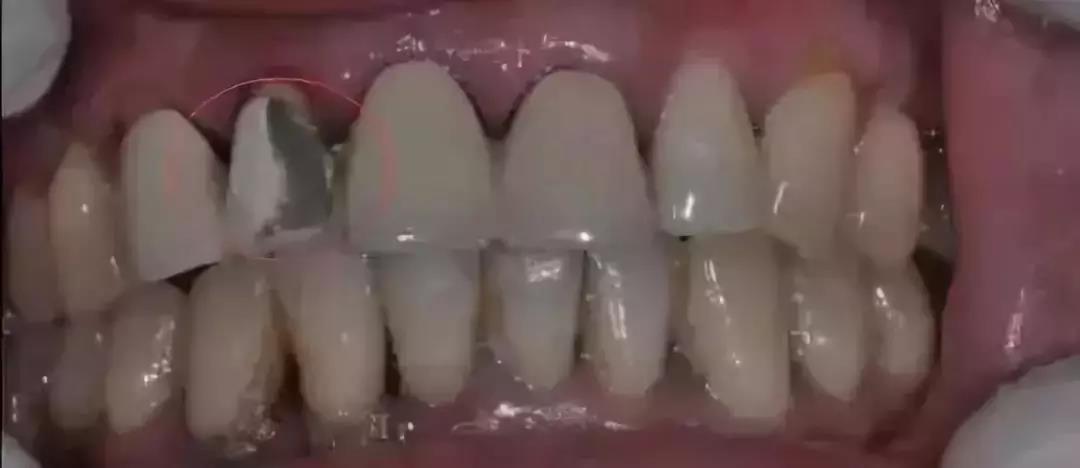 罗兰烤瓷牙,牙科最便宜的全瓷牙是什么品牌