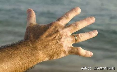 干细胞疗法的这个作用，改善了白癜风的免疫紊乱状况