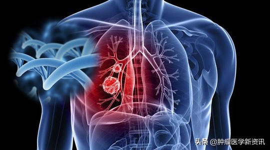 肺癌早期的6个信号中医治癌,肺癌正确的抗癌方法
