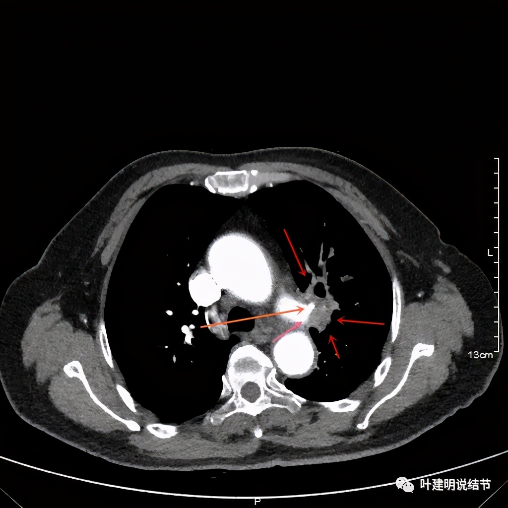 中央型肺癌手术前辅助治疗,中央型肺癌治疗后活过10年的病例
