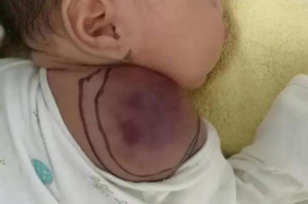 卡梅综合征说明什么,卡梅现象与卡梅综合征