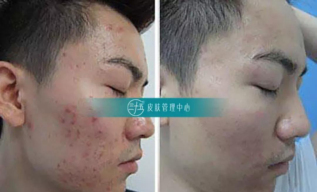 痘痘反反复复试试这招祛痘不用愁,青春期去除痘痘最有效的祛痘神器