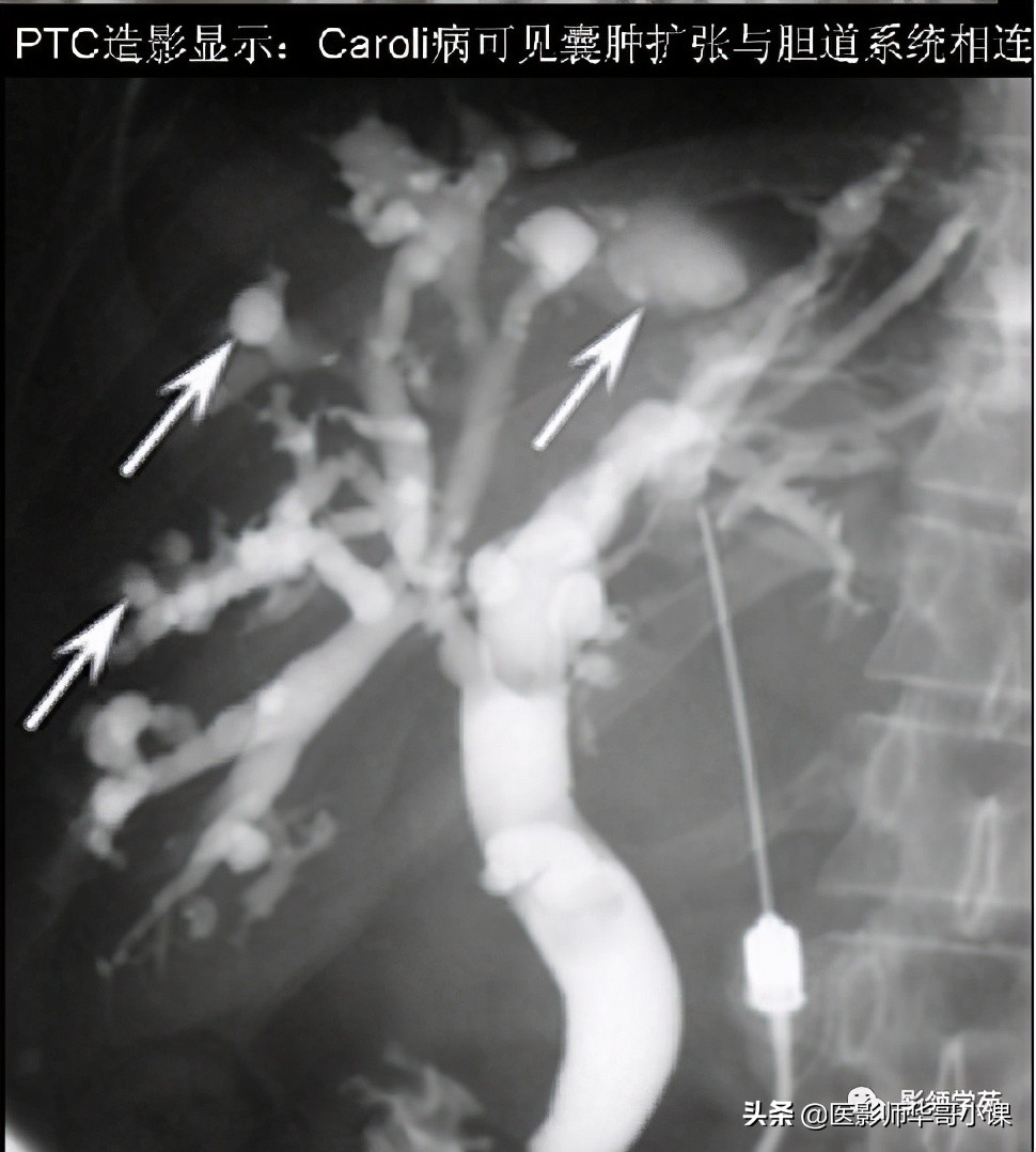 胆总管变异,胆胰管解剖