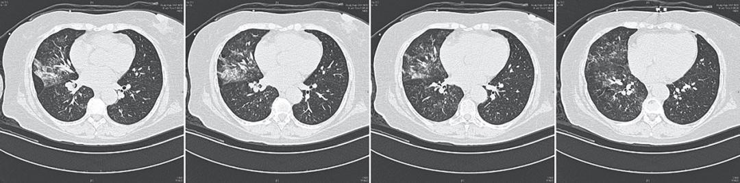 「梦里与丈夫吵架」醒来后咯血，是什么导致了她右侧支气管阻塞？
