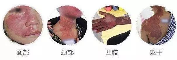 宝宝身上突然长了类似胎记,婴儿身上长的灰色胎记是怎么回事