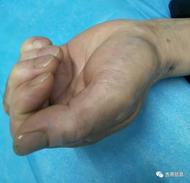 中医院介入三氧疗法,慢性疼痛介入治疗方法