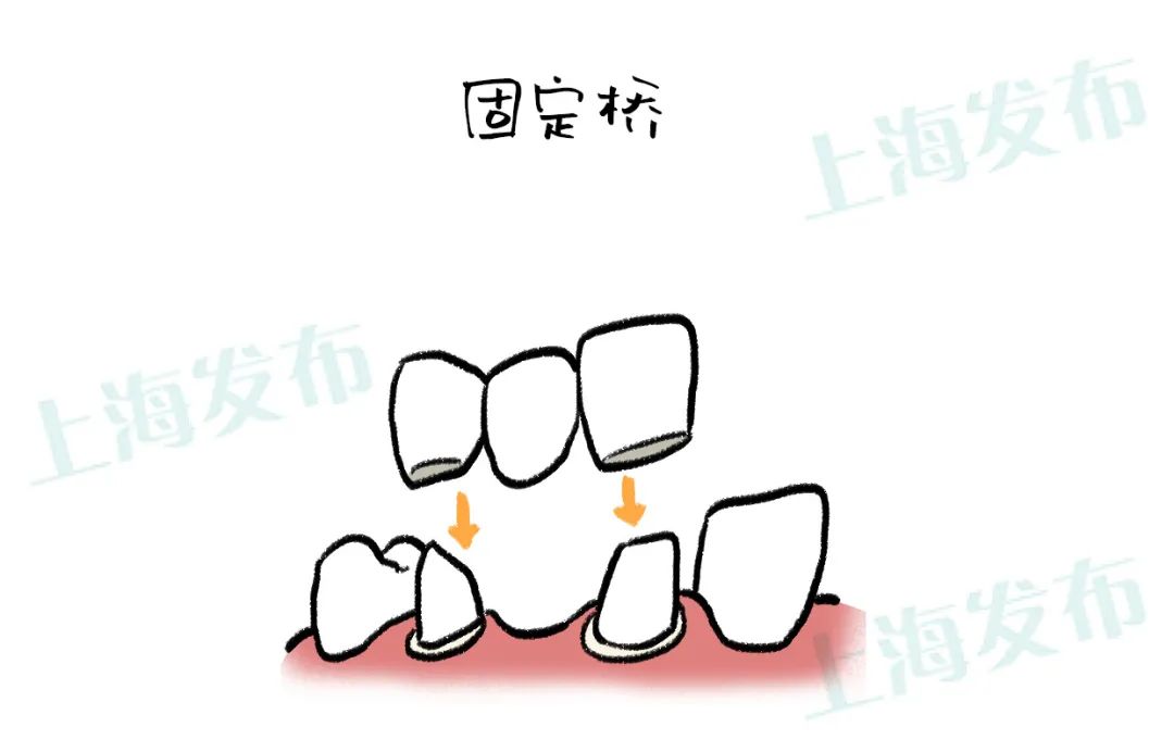 牙疼牙医把牙神经断了会怎么样,牙疼要不要毁掉牙神经