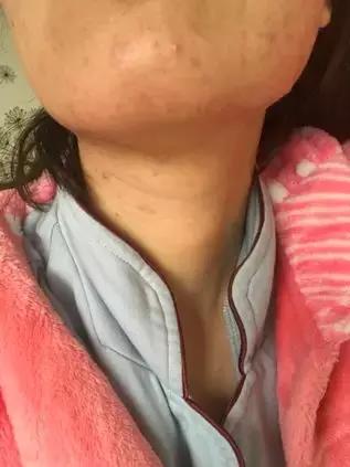 「许师解疑」难治性*疮痤**案析酸寒法