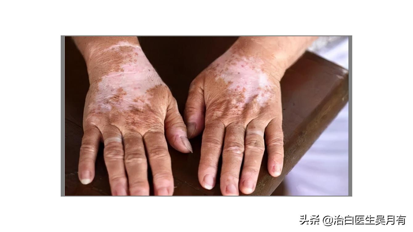 手部白癜风怎么鉴别,白癜风鉴别方法