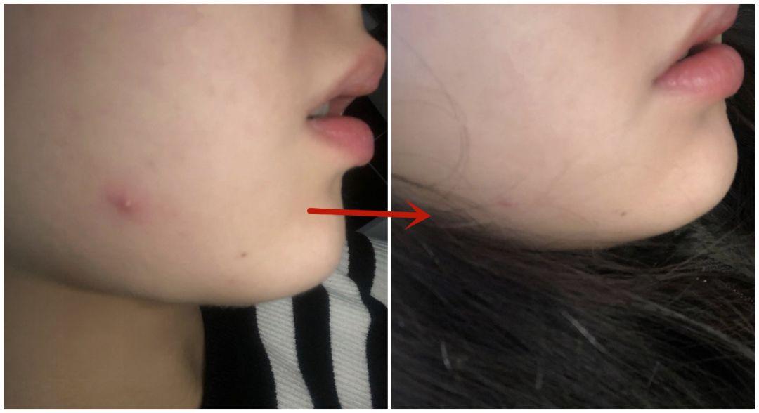 超好用的祛痘膏便宜,有没有好用的祛痘膏推荐女孩子