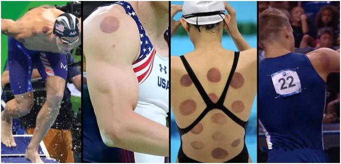 神秘“东方力量”再现奥运会！原来中医拔罐有这么多好处