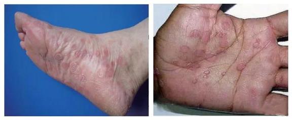 梅毒伪装,伪装者罪行