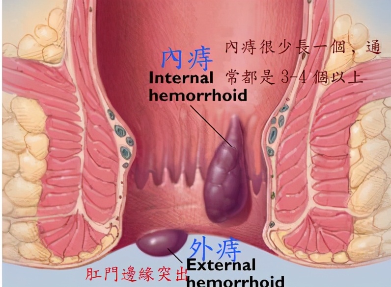 最新的中医肛肠科常见病诊疗指南,肛肠科中医适宜技术有哪些