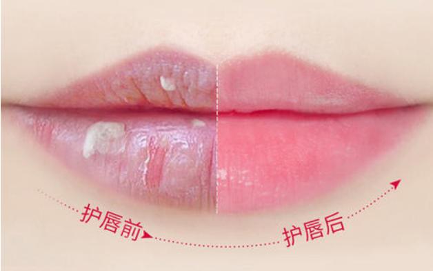 唇纹多怎么改善,唇纹怎么改善医美