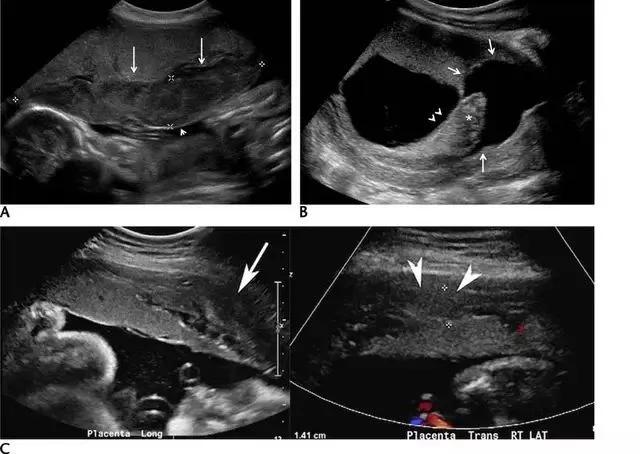 临床上最常见的异常胎盘,前置胎盘和低置胎盘超声