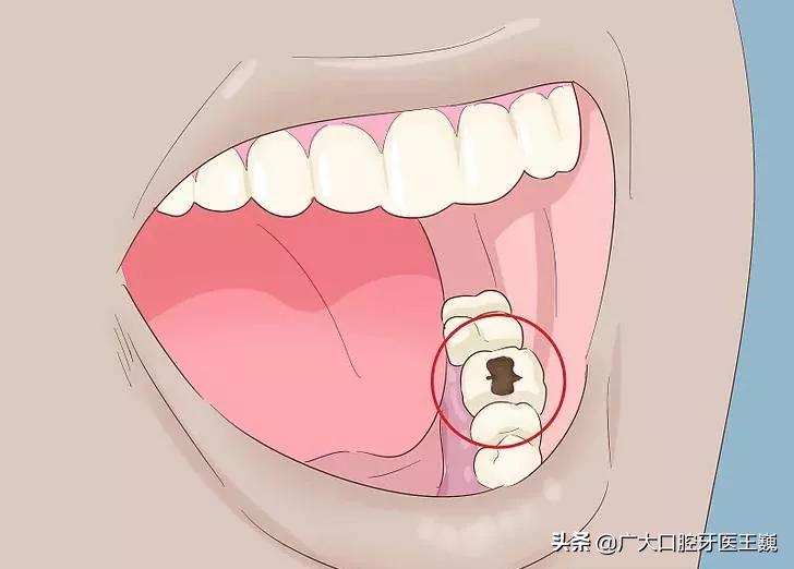 烤瓷牙里面的牙齿腐烂视频,牙齿从牙根开始腐烂怎么办