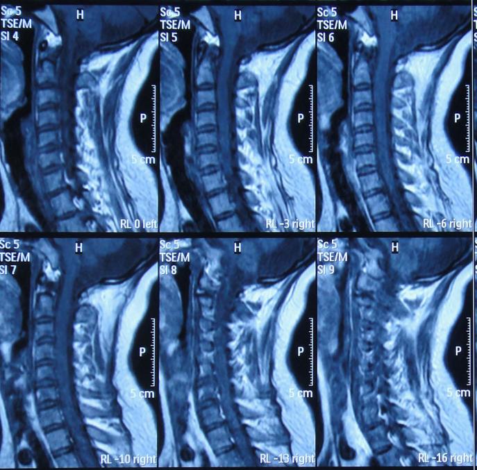 结核性脑积水,脑膜炎脑积水要治疗多久