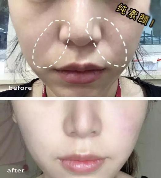 硬刚女皇龙妈也扛不住法令纹，2条沟壑让人心疼，贴一贴就消了