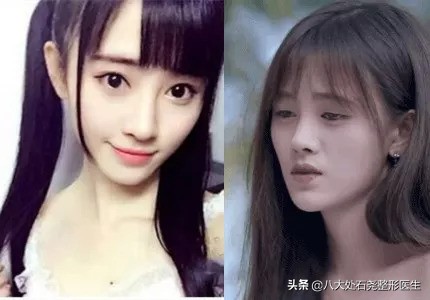 明星太阳穴凹陷怎么解决,太阳穴填充的明星