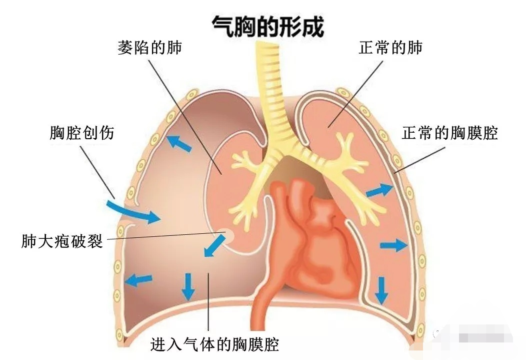 打仗胸部中弹怎么办,士兵中弹怎么治疗