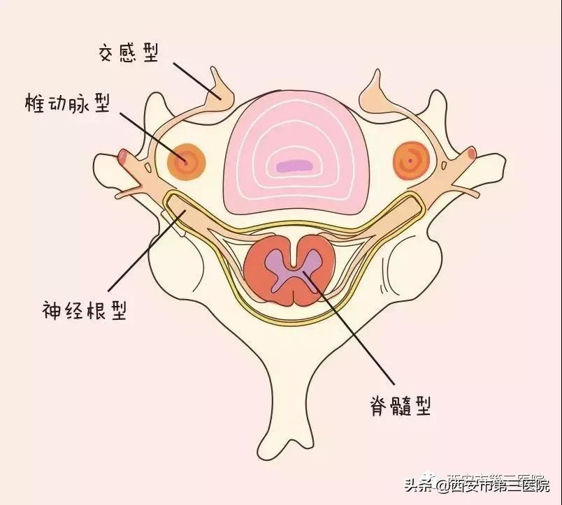 如何判断何种类型的颈椎病,最简单的颈椎病自测方法