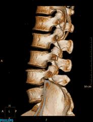髂腰肌紧张的原因是什么,髂腰肌紧张和腰方肌紧张