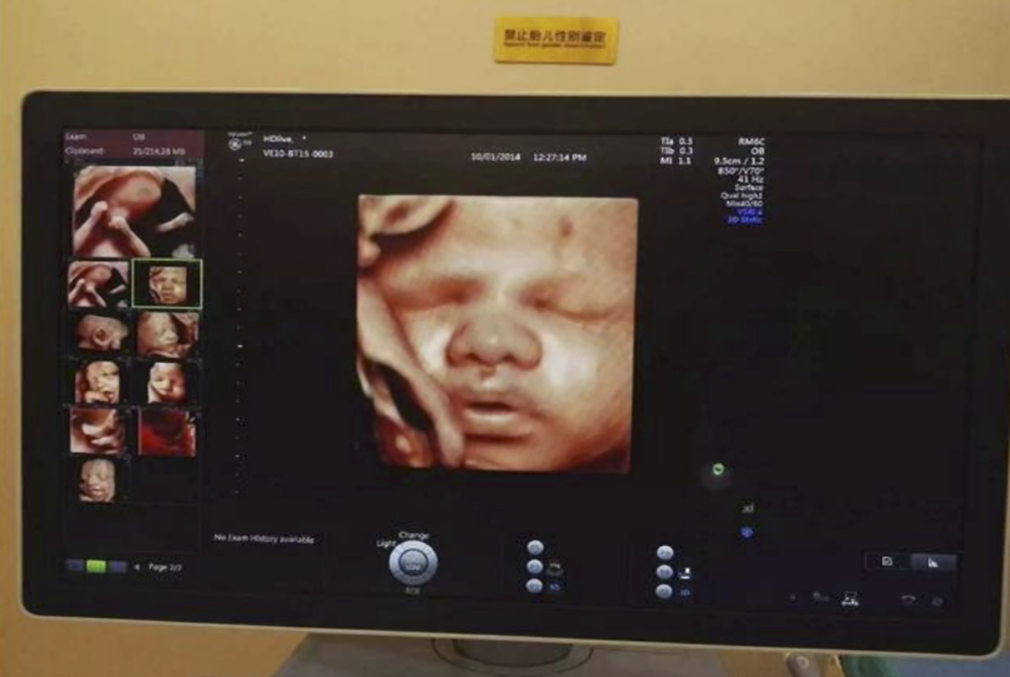 胎儿四维照“鼻梁塌陷”,宝爸质疑妈妈基因伪劣,出生后却很惊喜