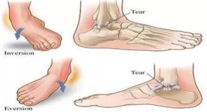咯嘣一声腰就疼了是怎么回事,扭到脚咯嘣一下是怎么回事