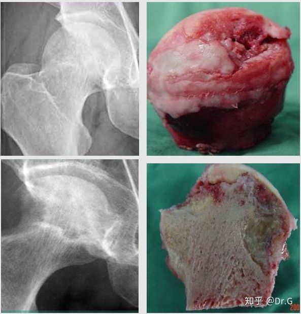 短时间用激素一定会股骨头坏死吗,没服过激素会股骨头坏死吗